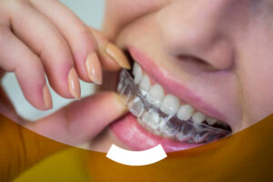 Lee más sobre el artículo Sonríe con confianza: descubre la ortodoncia invisible en Witizz